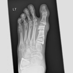 Flat foot - after