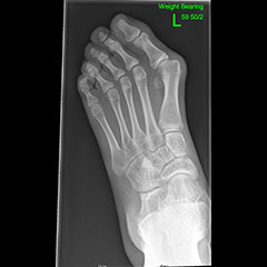 Flat foot - before